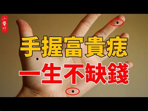 女右手掌突然長痣|手相專家：掌痣暗示何事？